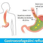 Reflux žaludeční kyseliny (kyselý reflux) – příznaky, příčiny a jak se léčí?