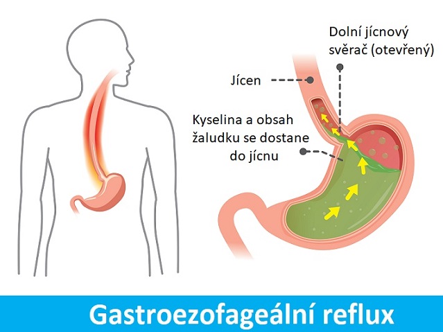 Gastroezofageální reflux ( anglicky gastroesophageal reflux disease - GERD) je zpětný tok žaludečních šťáv ze žaludku do jícnu.