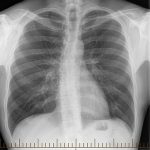 Plicní fibróza – co je to – příznaky, příčiny a léčba