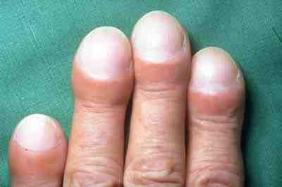 Kulatější konečky prstů mohou být příznakem plicní fibrózy u některých lidí