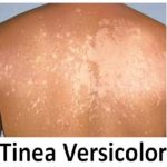 Pityriasis versicolor (tinea versicolor) – co je to – příznaky, příčiny a léčba