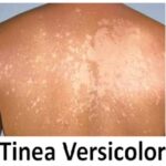 Pityriasis versicolor (tinea versicolor) – co je to – příznaky, příčiny a léčba