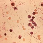 Shigella infekce (shigellóza) – co je to – příznaky, příčiny a léčba