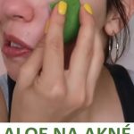 Aloe Vera na akné – recepty a účinky