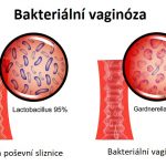 Bakteriální vaginóza – jak na ni? – příznaky, příčiny a léčba