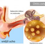 Zánět zvukovodu (plavecké ucho, zánět zevního ucha) – co je to – příznaky, příčiny a léčba