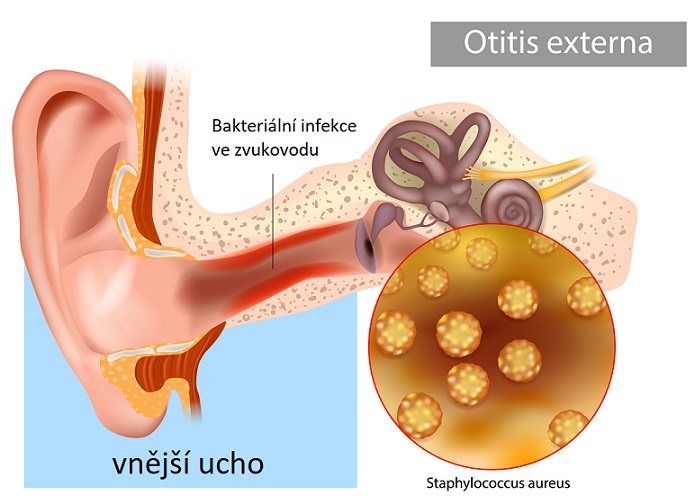 Zánět zvukovodu (plavecké ucho, otitis externa)