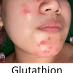 Glutathion na pleť a při akné – jaké má účinky?