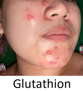 Glutathion na pleť a při akné - jaké má účinky?