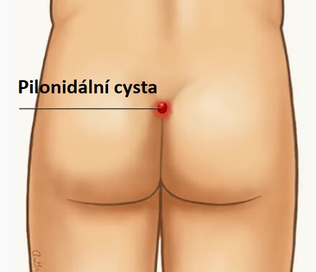 Pilonidální cysta