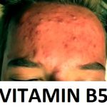 Vitamín B5 (kyselina pantotenová) na pleť a akné – jak a proč ho použít?
