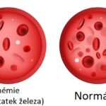 Hemolytická anémie – předčasné ničení červených krvinek v těle – příznaky, příčiny, léčba