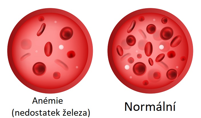 Porovnání krve (anémie - nedostatek železa x normální krev)