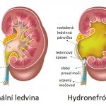 Hydronefróza – co je to – příznaky, příčiny a léčba