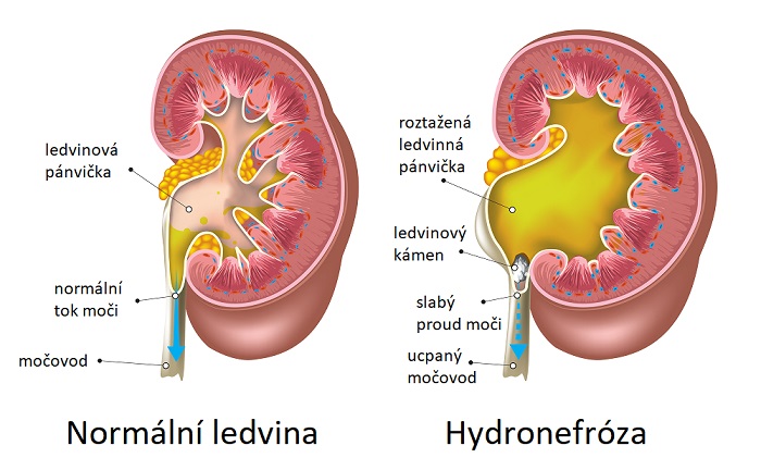 Obrázek - Hydronefróza