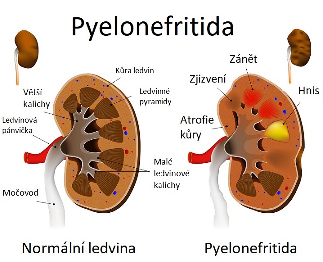 Obrázek - Pyelonefritida