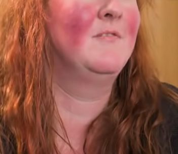 Jak se dá léčit rosacea na tváři?