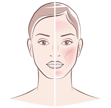 Suchá kůže se objevuje na obličeji nebo těle tehdy, ztratí-li svoji schopnost se chránit, když dojde k oslabení její ochranné funkce, neboli kožní bariéry.