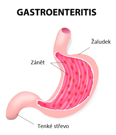 Virová gastroenteritida (žaludeční chřipka) je celkem častý problém.