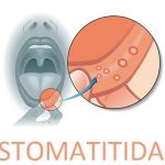 Stomatitida – co je to – příznaky, příčiny a léčba