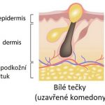 Jak na bílé tečky (uzavřené komedony)?