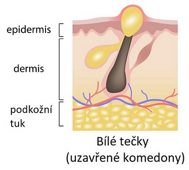 Bílé tečky jsou formou akné, které zůstávají pod kůží, ale vytvářejí na pleti vyvýšený bílý hrbolek.