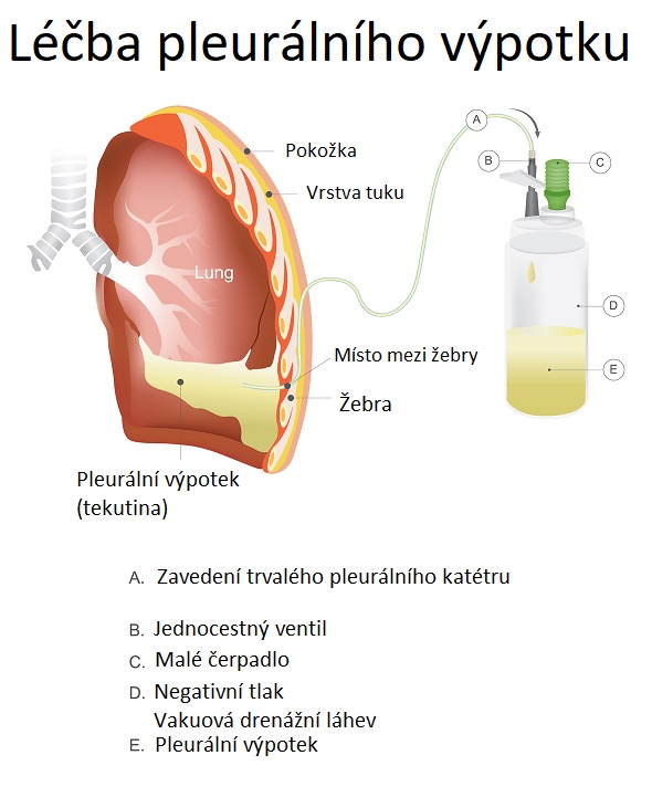 Jak se léčí voda na plicích?