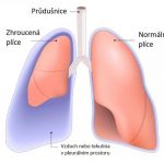 Propíchnutá plíce (pneumotorax, zhroucená plíce) – příznaky, příčiny a léčba
