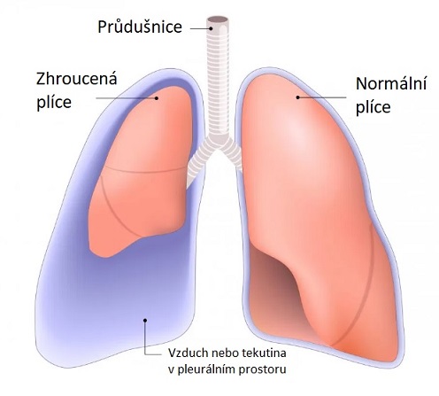 Obrázek: Zhroucená plíce