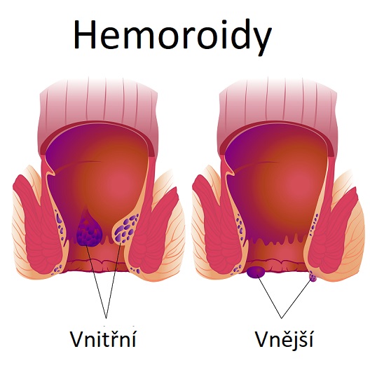 Druhy hemoroidů