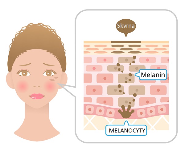 Takto vznikají tmavé skvrny na obličeji i jinde na těle