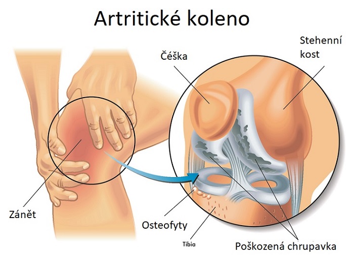 Artritida v kolenním kloubu