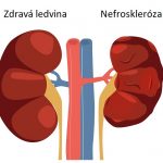 Nefroskleróza ledvin – co je to – příznaky, příčiny a léčba