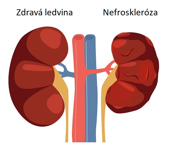 Obrázek: zdravá ledvina a ledvina s nefrosklerózou