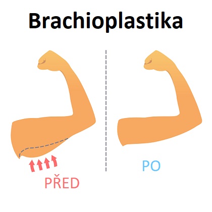 Brachioplastika neboli plastická operace paží řeší kožní a tukové nadbytky vnitřní strany paží.