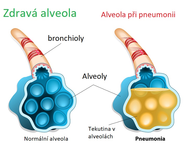 Zdravé alveoly vs. alveoly při pneumonii
