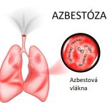 Azbestóza – co je to – příznaky, příčiny a léčba