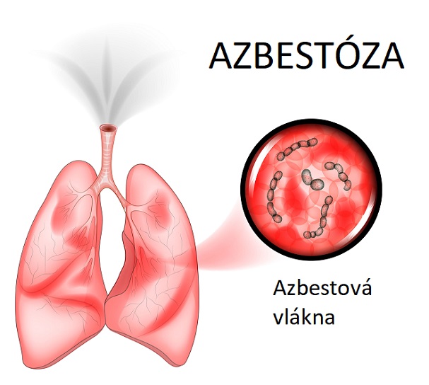 Azbestóza je závažné onemocnění plic a dýchacích cest způsobené vdechováním azbestových vláken. Azbestové vlákna jsou malé a velmi tenké, a proto se mohou snadno dostat do plic a usadit se tam. Tam mohou způsobit záněty a jizvy, které mohou vést k vážným onemocněním, jako je azbestóza.
