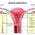 Biopsie endometria – co je to + jak a kdy se provádí?