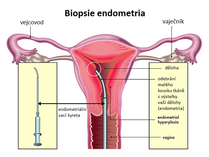 Biopsii endometria provádí obvykle gynekolog nebo specialista na reprodukční medicínu