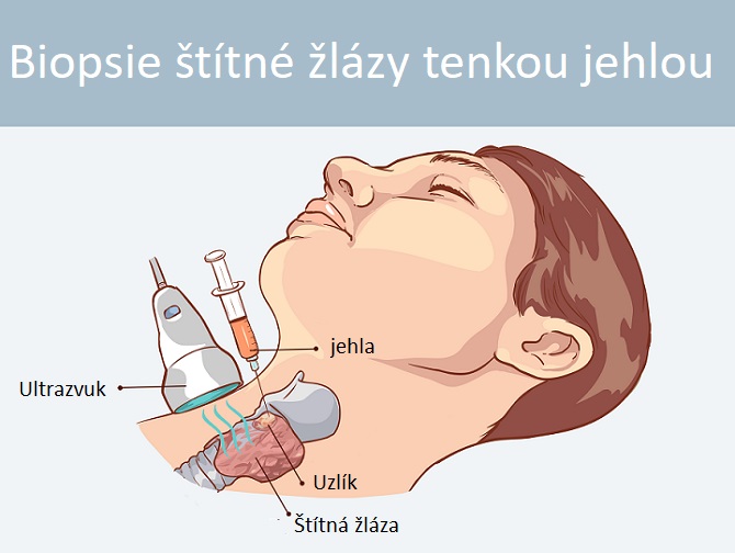 Biopsie štítné žlázy tenkou jehlou - infografika