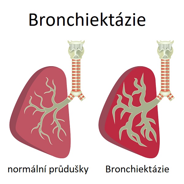 Bronchiektázie jsou onemocnění, které se vyskytuje při trvalém rozšíření a poškození průdušek, které vedou do plic. V důsledku této deformace průdušek může dojít k hromadění hlenu a bakterií, což může vést k opakovaným infekcím plic.