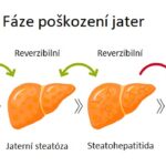 Selhání jater – co je to – příznaky, příčiny a léčba