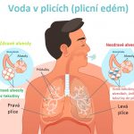 Voda v plicích (plicní edém) – proč nastává? Příznaky, příčiny a léčba