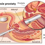 Biopsie prostaty – kdy se provádí a jak to probíhá?