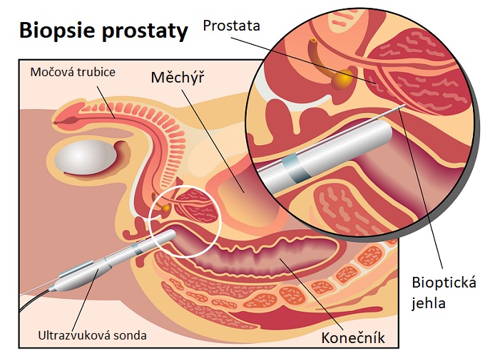 Biopsie prostaty