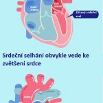 Srdeční selhání – důležité informace – příznaky, příčiny a léčba