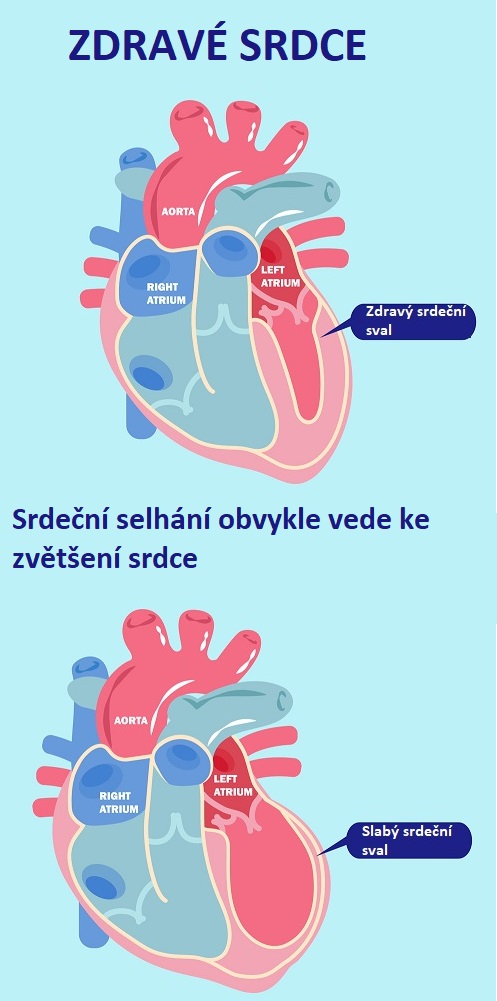 Infografika - srdeční selhání