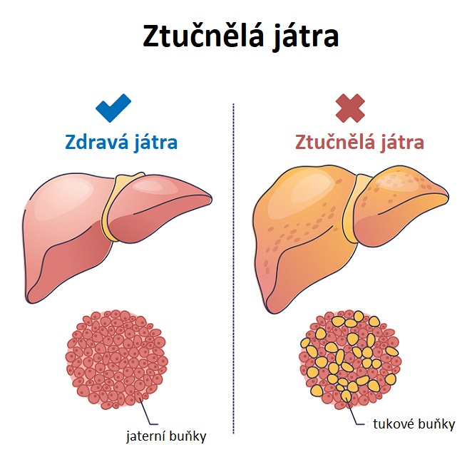 Zlepšení životního stylu, jako je snížení hmotnosti, pravidelné cvičení a omezování konzumace alkoholu může pomoci snížit množství tuku v játrech.