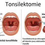 Tonsilektomie – co je to a jak probíhá?